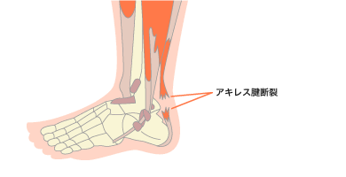 義肢装具 義足 メーカー | 疾患×装具 | アキレス腱断裂 | テクノ